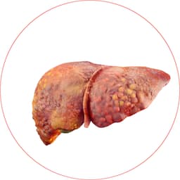 Fat Accumulation in Liver (Fatty Liver)